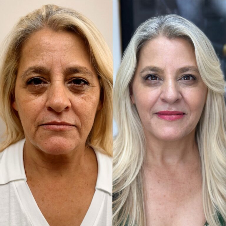Como Evitar o Efeito Artificial na Harmonização Facial