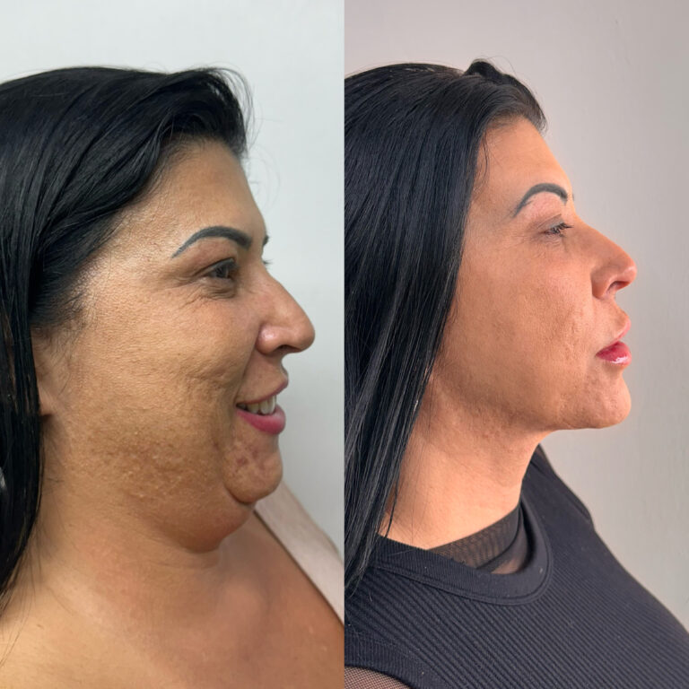 Lipo de Papada