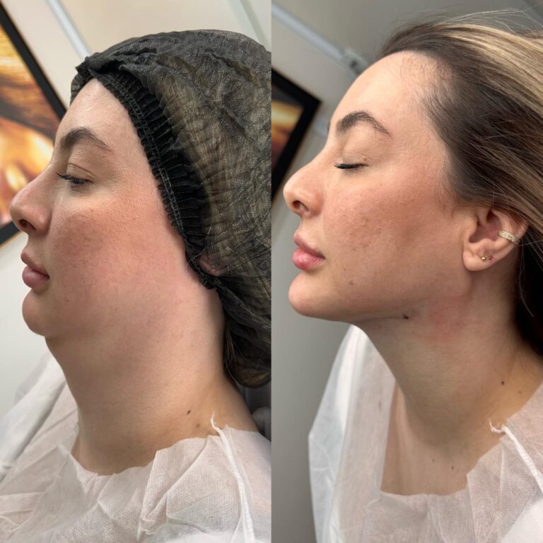 Lipo de Papada ou Bioestimuladores